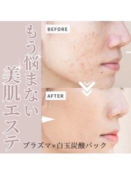 エヌ スタイル(N Style)/ハーブピーリング