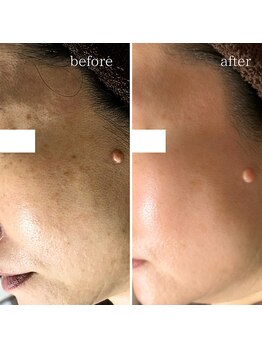 マーギアー(Magier)/ハーブ＋ダーマ　初来店→５回目