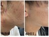 美容外科提携＊2回目以降リベルハーブピーリング　首、肩、頭マッサージ付き