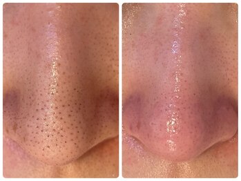 ヒメミ(Himemi)/毛穴エクストラクションtete式