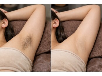 ルネル(Lunelle)/脇脱毛で自己処理から解放☆