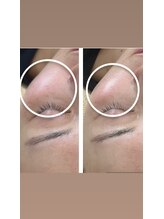 リバイセリー(Revicelly)/施術比較