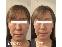 シェリール(Cherir)/小顔矯正