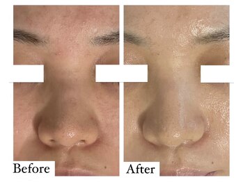 ベル 恵比寿(Belle)/REVI陶肌ハーブピーリング