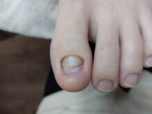 爪切り屋 足楽/爪甲鉤弯の爪