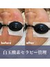 SNSで大注目されてる実績と注目の高い肌管理機器☆白玉酸素セラピー+LED管理