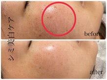 ルアナ(LUANA)/シミ美白ケア