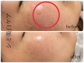 ルアナ(LUANA)/シミ美白ケア