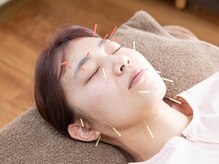 叶(kanae)/美容鍼の施術（顔）