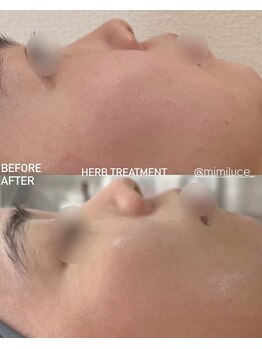 ミミルーチェ(mimiluce)/頬の毛穴消したい人はハーブ◎