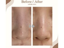 ラヴィ コロレ(La vie colore)/光フェイシャル×パック