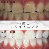 ホワイトスマイル(White Smile)