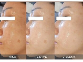 ミハン ボーテ(mihan.beaute)/【シミ・くすみ・色素沈着】