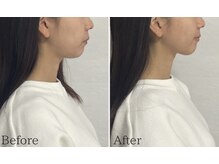 リタ(Rita.)の雰囲気（リフトアップして顎下もスッキリ、横顔美人に）