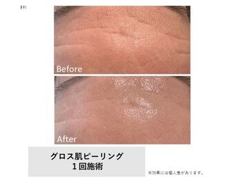 ティンク 心斎橋(Tink)/水素美容