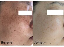 マインドール/頑固なシミも集中ケアで変化！