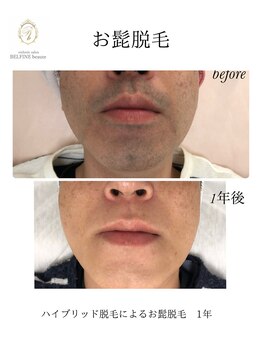 ベルフィーヌボーテ(BELFINE beaute)の写真/【青ヒゲ卒業】毎朝のヒゲ剃り時間を短縮！清潔感UP◎