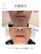 ベルフィーヌボーテ(BELFINE beaute)の写真/【青ヒゲ卒業】毎朝のヒゲ剃り時間を短縮！清潔感UP◎