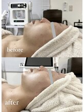 サロン スリーバイエス(salon THREE/S)/超音波shot小顔コース 8000shot