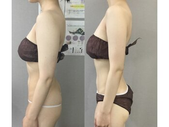 ヴィノ アイサロン(VINNO eyesalon)/巻き肩、ストレートネックの方に