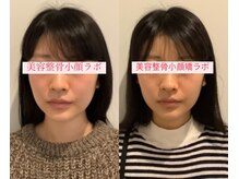 美容整骨小顔ラボ/小顔矯正ビフォーアフター