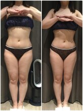 アイスタイル(i-style)/脂肪冷却/痩身ダイエット/泉大津