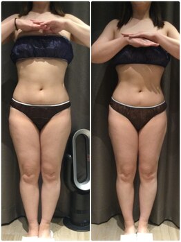 アイスタイル(i-style)/脂肪冷却/痩身ダイエット/泉大津