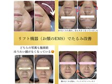 ミヤビ(MIYABI)の雰囲気（リフト機器（お顔のEMS）でお顔のコリ取れリフトUpに繋がります）
