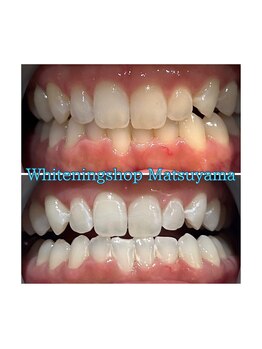 ホワイトニングショップ 松山店/結果重視サロン