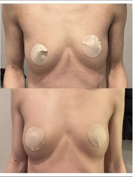 エルミナ.(elmina.)/垂れ&左右差改善♪美乳へ変化！