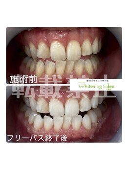 ホワイトニングサロン 札幌店/【ホワイトニング】#札幌#大通り