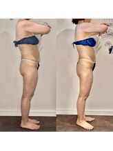 カルナ(CARNA)/【痩身】セルライトゼロ2