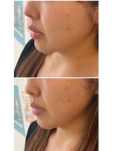 マヴィ 高槻店(MavY.)/フェイスラインに変化が！