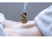 アキュパンクト ラボ 片山治療院(Acupunct Lab 片山治療院)/灸頭鍼