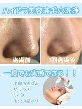 アネランスパ(Anelan Spa.)/ハイドラ毛穴洗浄で鼻ツルツル