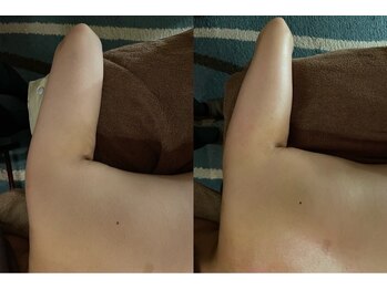 アユナタ(Ayu Natah)/2ヶ月集中二の腕ケアでスッキリ