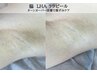 韓国ピーリング/水光肌【ざらつき・毛穴・黒ずみケア】脇LHAララピール¥9,800