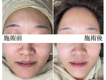 ディンプル(Dimple)/糸リフト16本