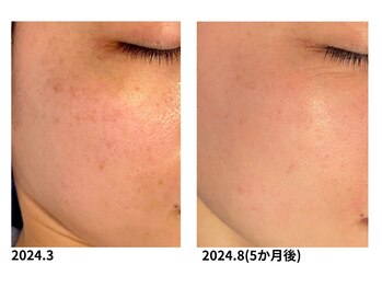 オーシャンブルー 長崎店(OCEAN BLUE)/美白・シミケア