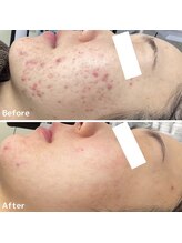 ニキビケア研究所 横浜店/赤み肌・赤ニキビケア