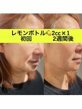  Ｌ’ｌａ　ｃｉｔｔａ【パーソナルカラー/毛穴洗浄/まつげパーマ/ヘッドスパ】/レモンボトル2cc