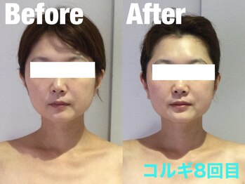 ビーキュート 学芸大学店(BE-CUTE)/Before/After 施術