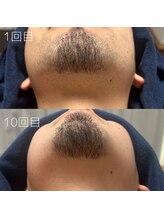 カナウ(KANAU)/ヒゲ脱毛（20代前半男性）