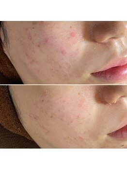 おうちサロン ミキ/しつこいニキビケアに◎