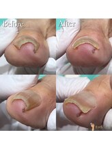 巻き爪補正店 湘南辻堂店/巻き爪・施術例