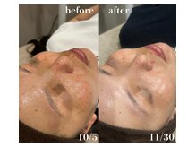 #美容革命ラボ 福岡春吉店/肌経過【天神春吉】