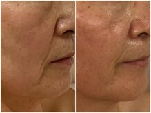 トータルビューティサロン クイーン(Queen)/●ほうれい線やマリオネット●