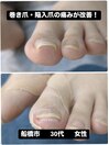 巻き爪・陥入爪・の痛みが改善!