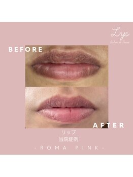 リスサロンドナース(LYS salon de Nurse)/ローマピンク