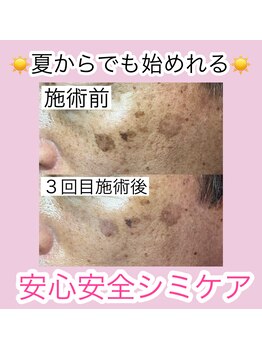 エミュ(emu)/当店のシミケア